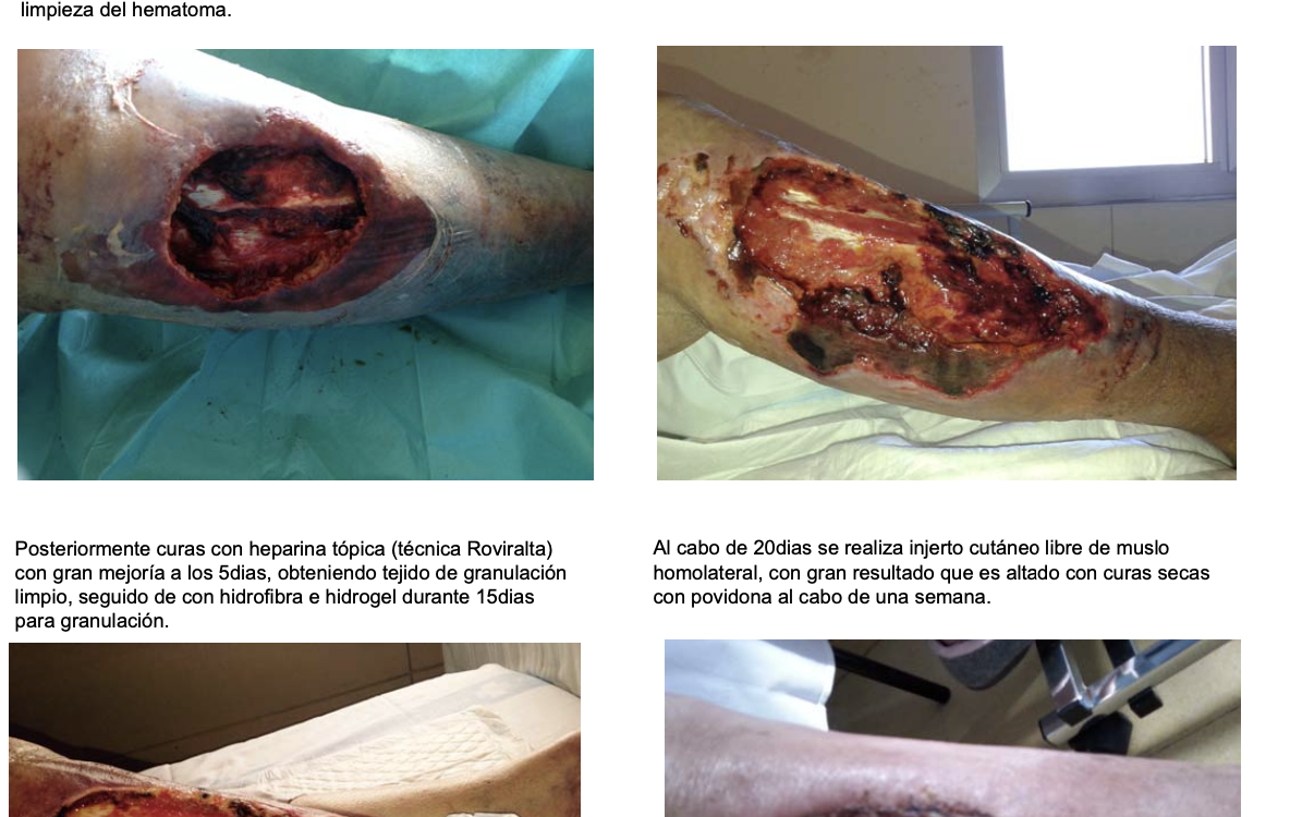 Aplicación del lavado con heparina (tecnica Roviralta) en hematoma en pierna por acenocumarol con reparación con injerto libre.
